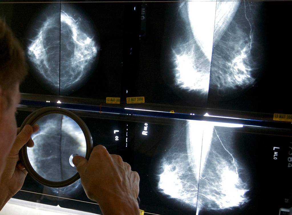 Radiologist uses magnifying glass to check mammograms for breast cancer